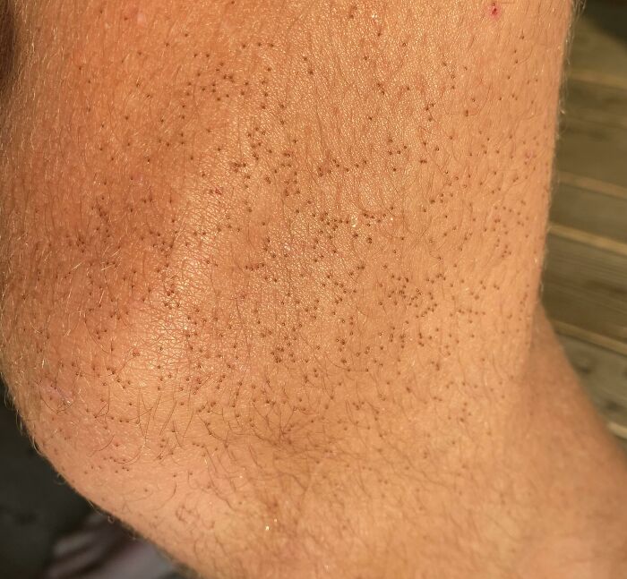 A close-up of skin covered in tiny red dots, a terrifying nature pic.