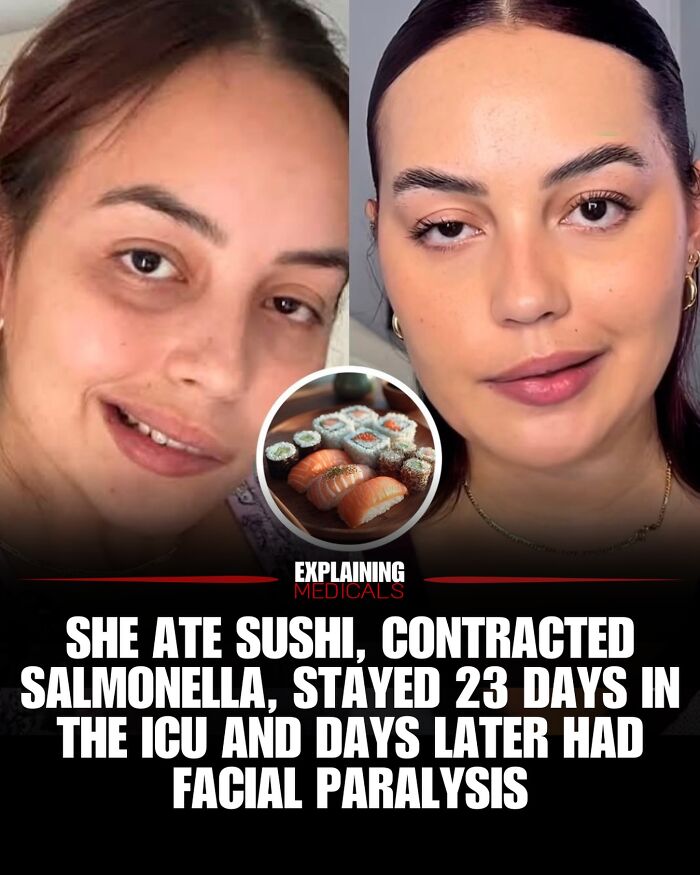 Facial paralysis case after salmonella from sushi infection