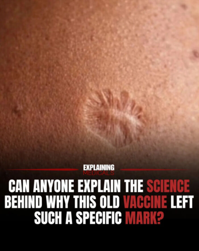 Old vaccine scar leaving specific mark on skin explained by science