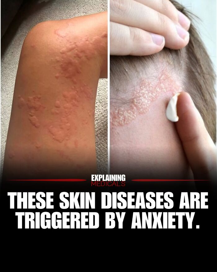 Skin diseases triggered by anxiety shown through rash treatment