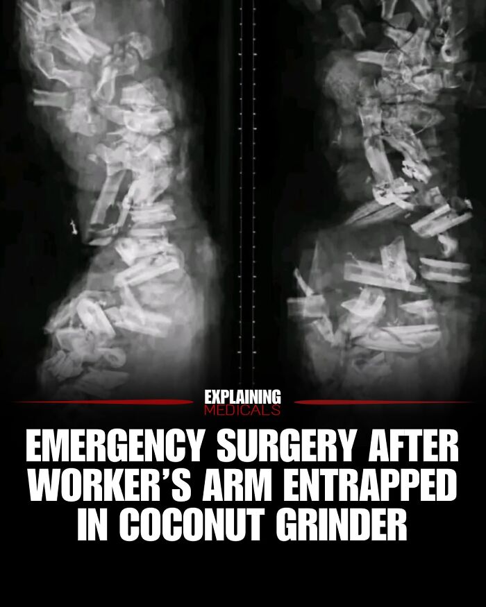 X-ray image of emergency surgery after worker’s arm trapped in coconut grinder