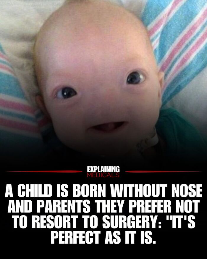 Child born without nose with parents declining surgery in health and human body facts