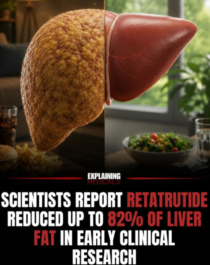 Retatrutide reduces up to 82 percent of liver fat in early clinical research.