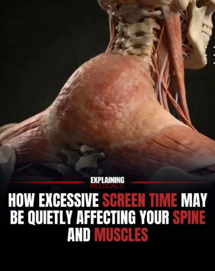 Excessive screen time impact on spine and muscles shown in body anatomy