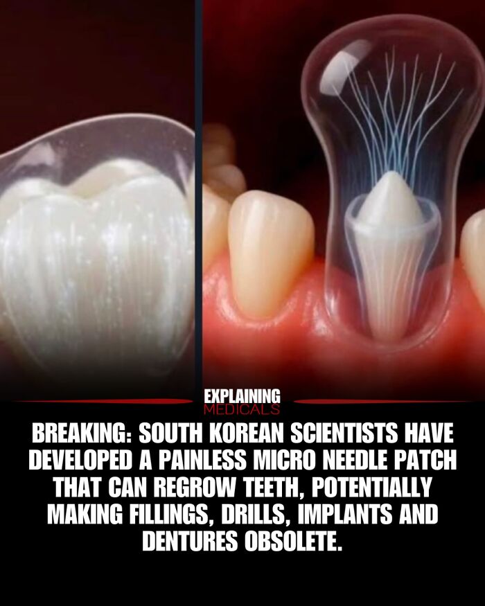 Micro needle patch developed to regrow teeth and eliminate dental work