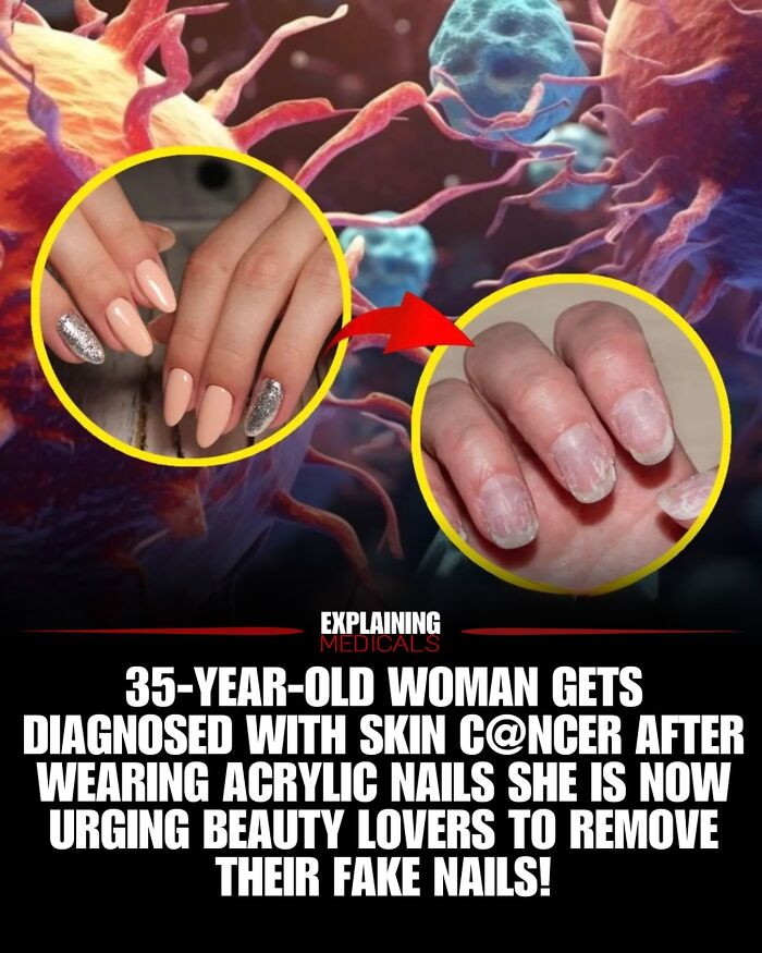 Woman diagnosed with skin cancer after using acrylic nails warns others to remove them