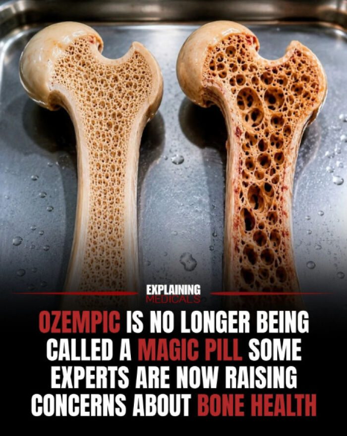 Comparison of healthy and porous bones highlighting bone health concerns