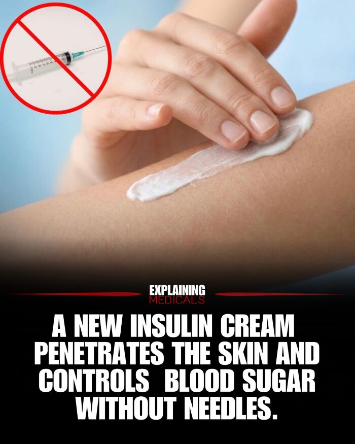 New insulin cream applied on arm controls blood sugar without needles