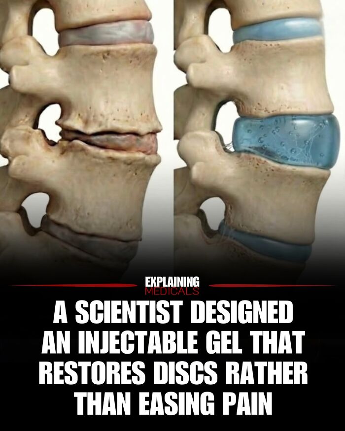 Illustration of injectable gel restoring spinal discs to reduce pain