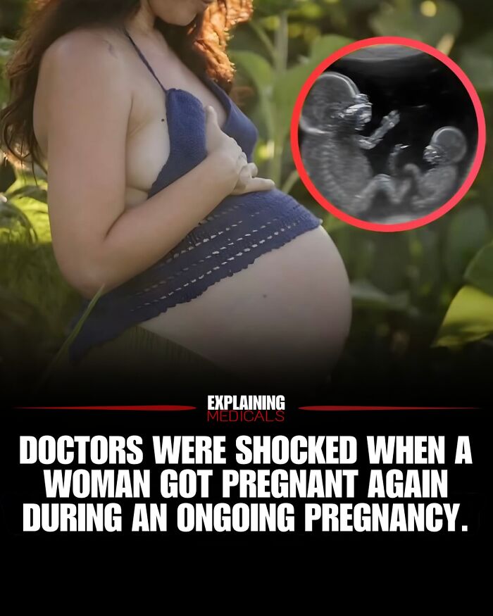 Pregnant woman with ultrasound of twins illustrating rare simultaneous pregnancy