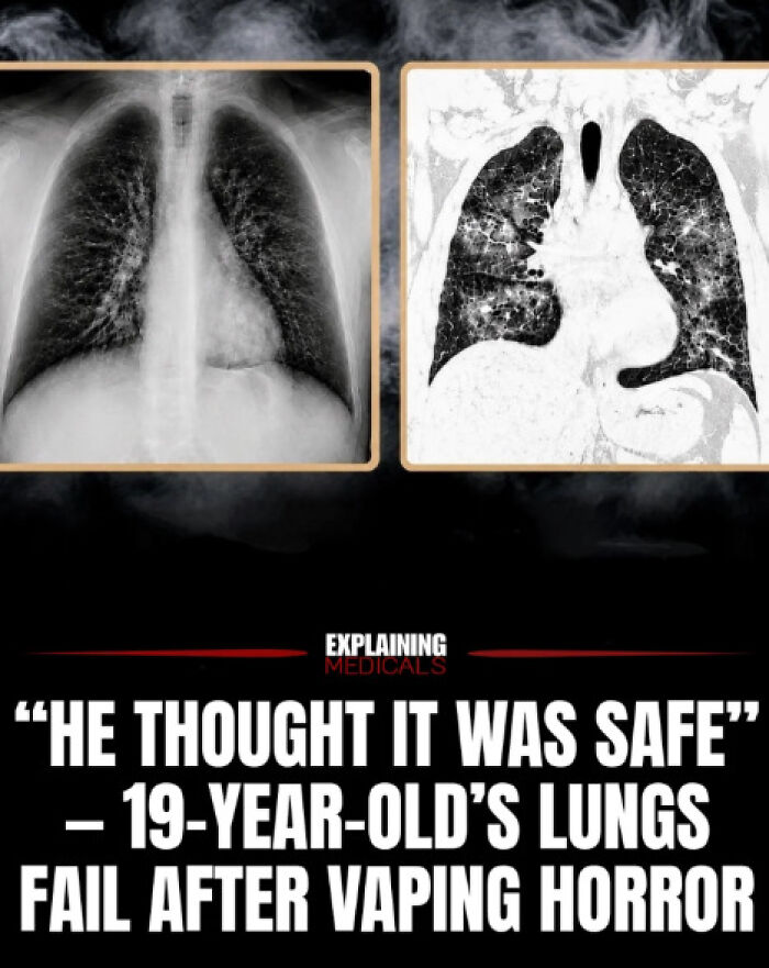 X-ray images show lung damage after vaping in 19-year-old
