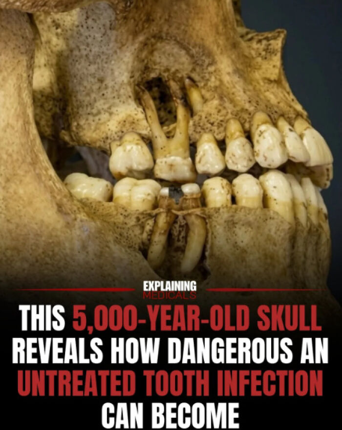 Ancient 5,000-year-old skull showing effects of untreated tooth infection