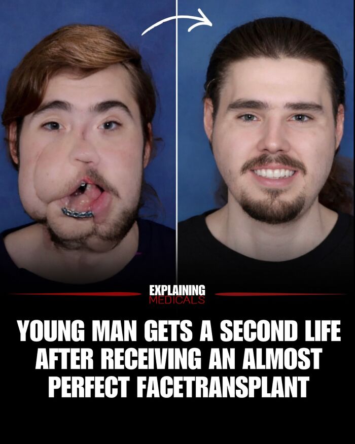 Young man transforms after receiving almost perfect face transplant surgery