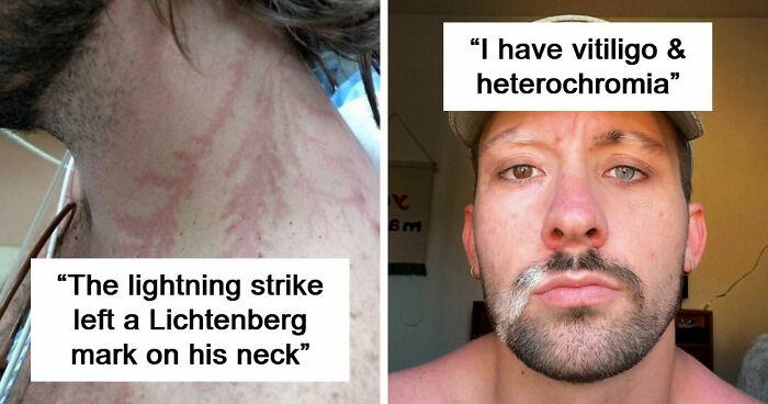 61 Interesting Photos Of Human Body Quirks That Are Both Fascinating And Shocking (New Pics)