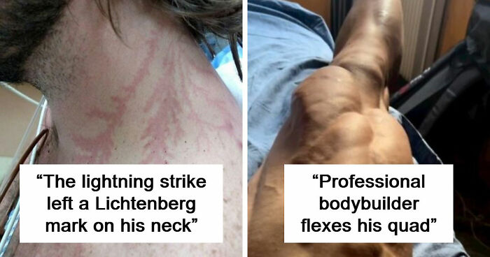61 Interesting Photos Of Human Body Quirks That Are Both Fascinating And Shocking (New Pics)