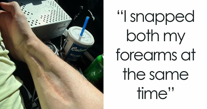 61 Interesting Photos Of Human Body Quirks That Are Both Fascinating And Shocking (New Pics)