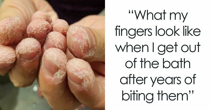 61 Interesting Photos Of Human Body Quirks That Are Both Fascinating And Shocking (New Pics)
