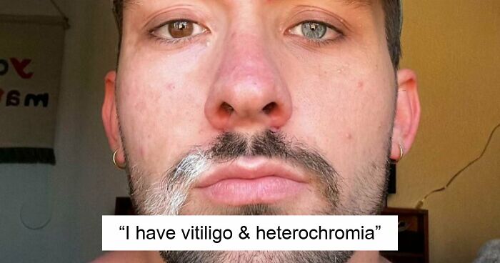 61 Interesting Photos Of Human Body Quirks That Are Both Fascinating And Shocking (New Pics)
