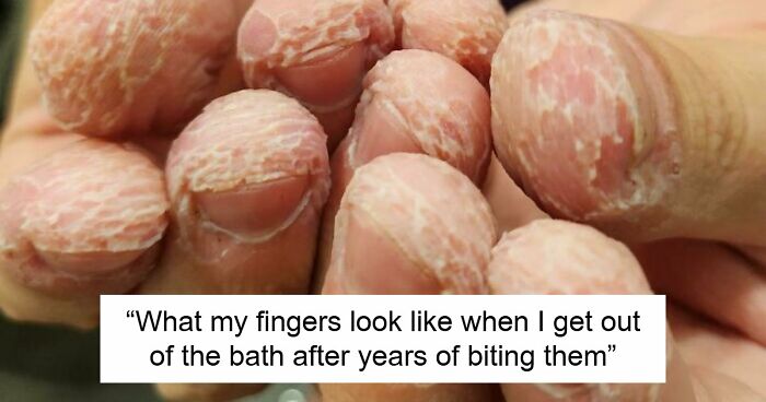 61 Interesting Photos Of Human Body Quirks That Are Both Fascinating And Shocking (New Pics)