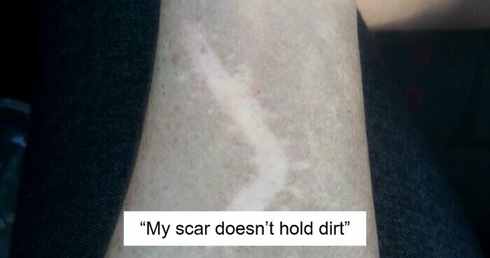 61 Interesting Photos Of Human Body Quirks That Are Both Fascinating And Shocking (New Pics)