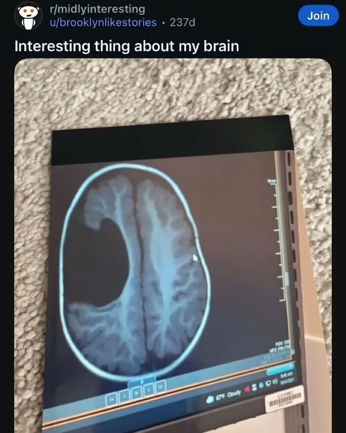 An X-ray of a brain with a large, unusual void, an interesting and funny brain anomaly.