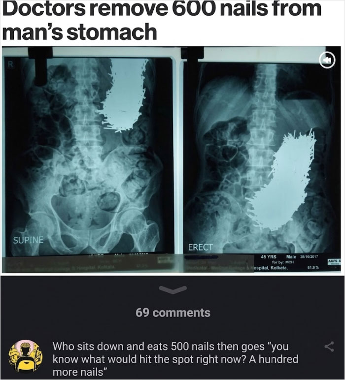 X-rays showing a stomach full of nails, with a savage comment below.