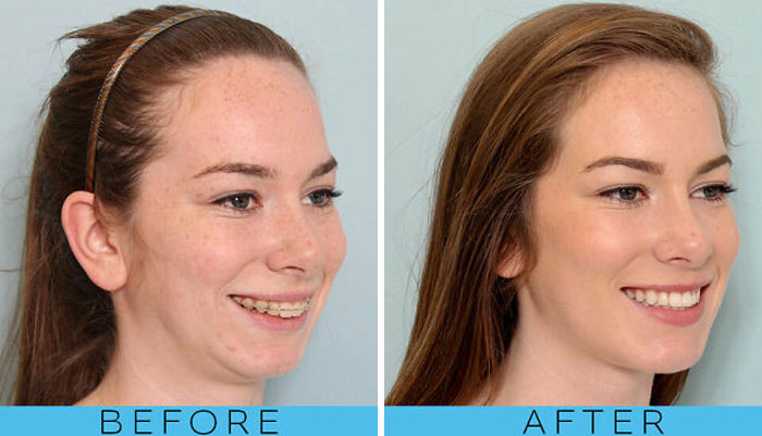Before and after photo of a woman's smile, showing the transformation of people who left everyone speechless at reunions.