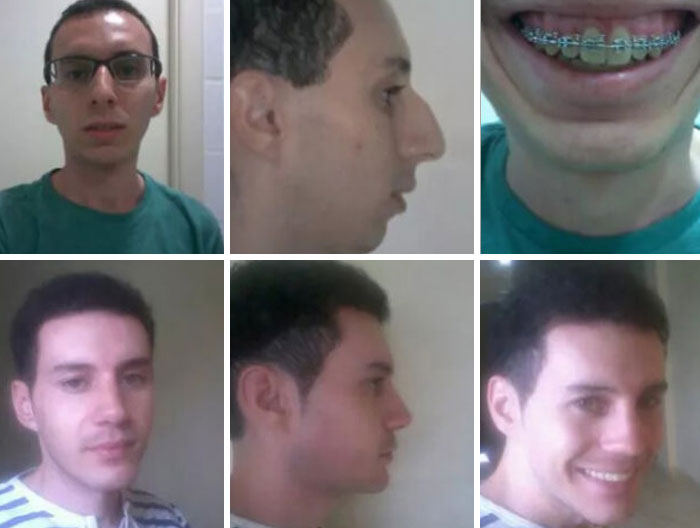 Side-by-side comparison of a person's facial transformation, leaving everyone speechless at reunions.