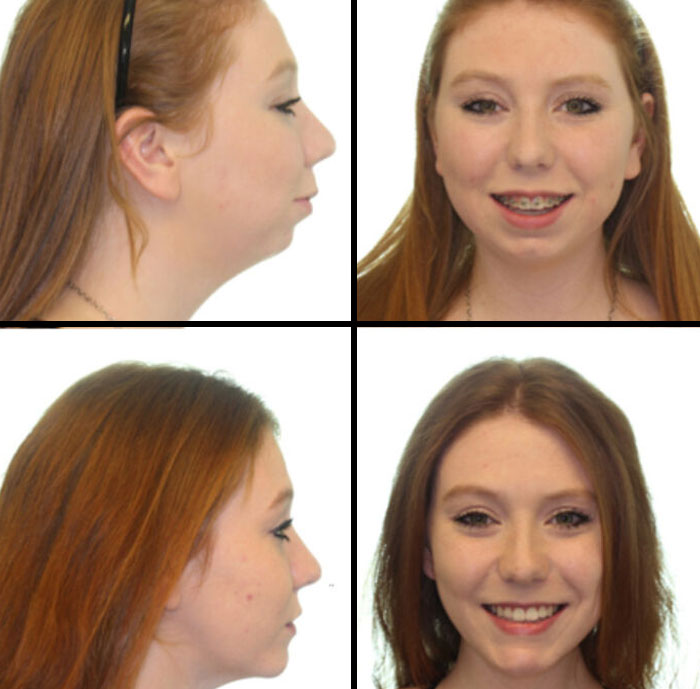 Young woman with red hair, before and after braces, smiling confidently at a reunion, leaving people speechless.