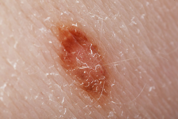 A close-up of a mole on skin, a medical symptom doctors wish people would not ignore.