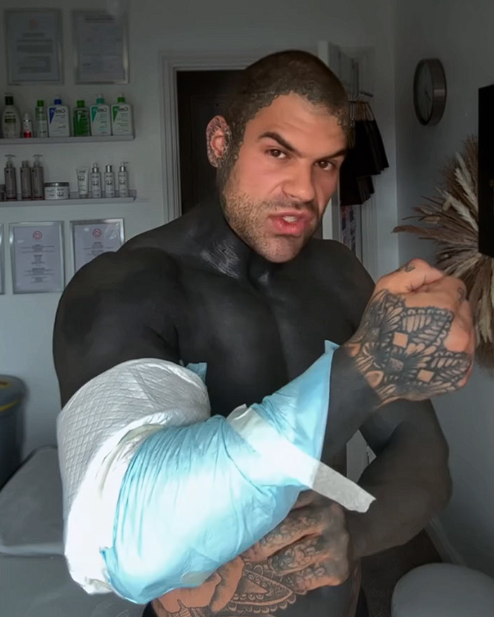 A man with blackout tattoos, a bandaged arm, revealing the harsh truths of the blackout tattoos trend and its healing process.