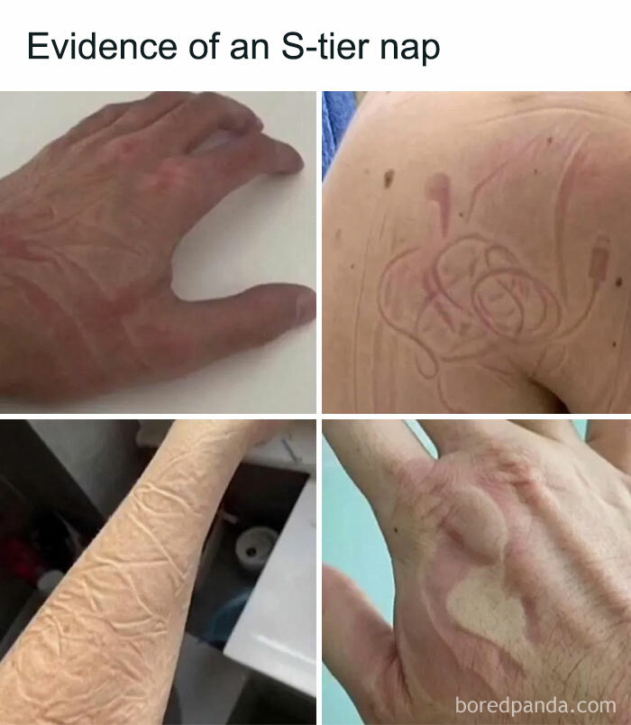 Red skin impressions on hand and arm from nap