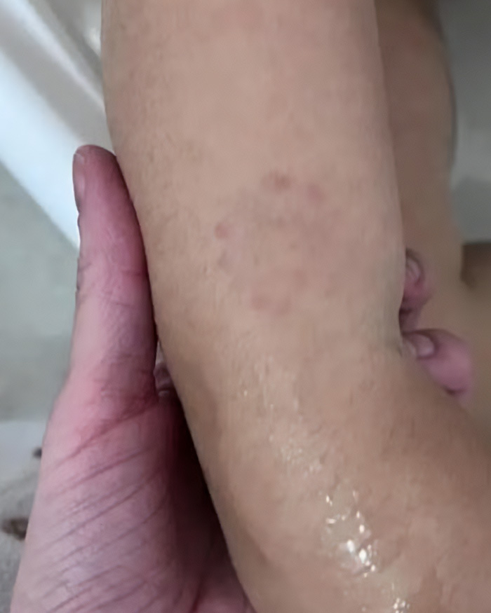 Close-up of a child's arm with red marks, related to a mom noticing her son's changed behavior.