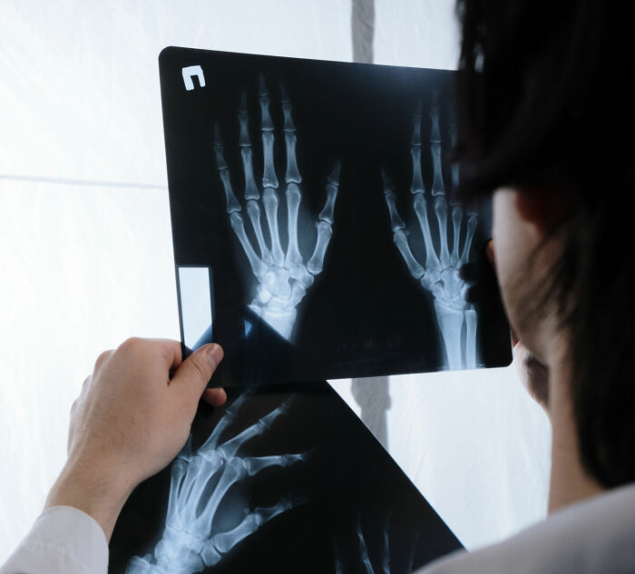 A doctor examines X-rays of hands, looking for a surprise hidden in a plaster cast.