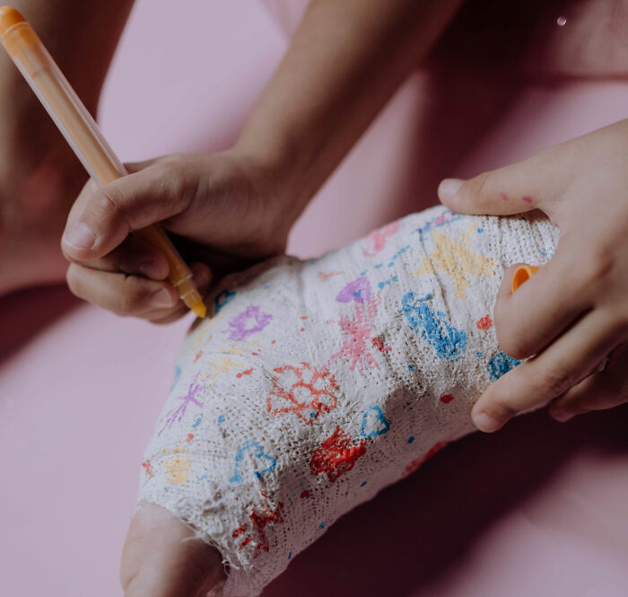 Boy decorates his plaster cast with colorful markers, a surprising find hidden within his cast.