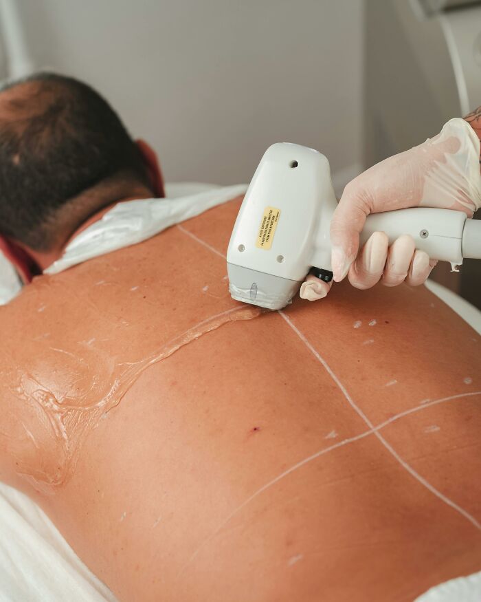 Close-up of laser hair removal on man's back