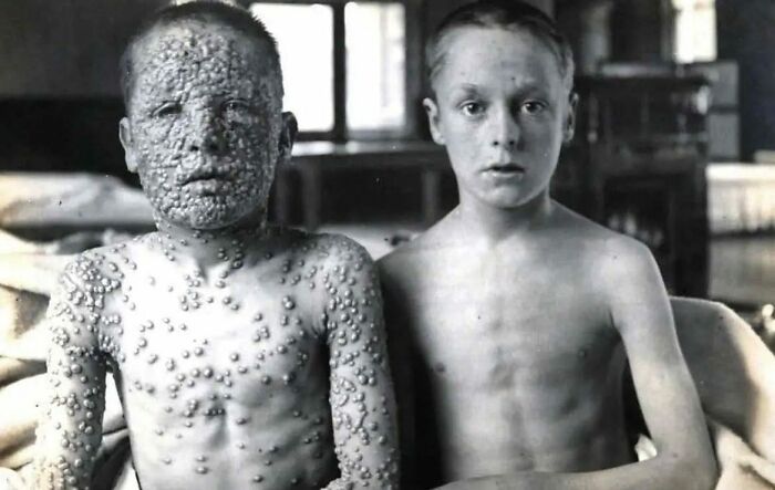 A black and white historical photo shows two young boys, one with a severe case of smallpox, the other seemingly unaffected.