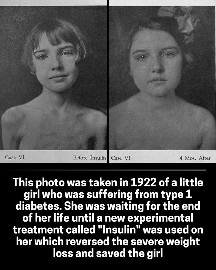 Before and after photos of a girl with diabetes, an interesting historical photo showing medical advancements.