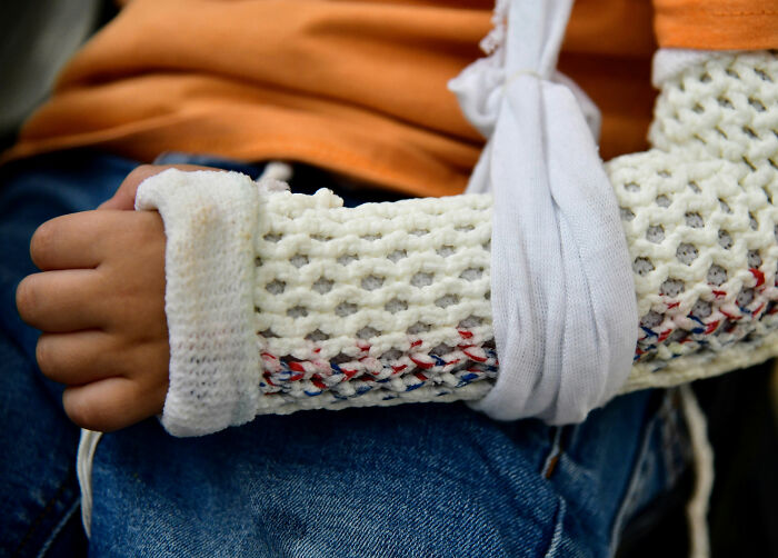 Close-up of a four-year-old boy's arm in a plaster cast, revealing a hidden surprise.
