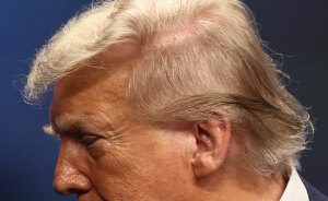 White House Accused Of Concealing Trump's Medical History After Truth About Hair-Loss Treatment Discovered
