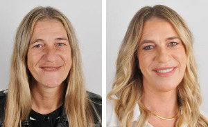 10 Jaw-Dropping Before-And-After Collages Of Women Who Underwent Extensive Smile Makeovers