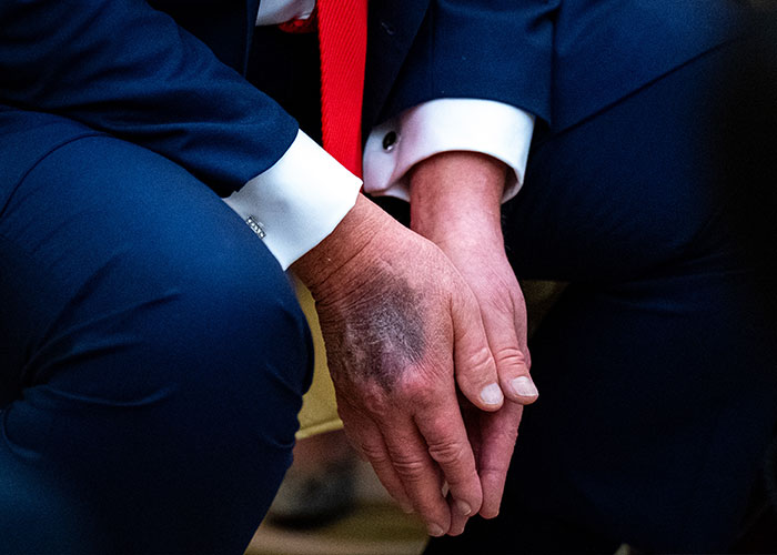 Close-up of bruised hands highlighting Trump's health issue Close-up of bruised hands highlighting Trump's health issue