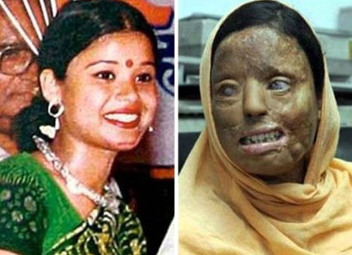Before and after photo of acid attack survivor showing severe facial scars creepy image