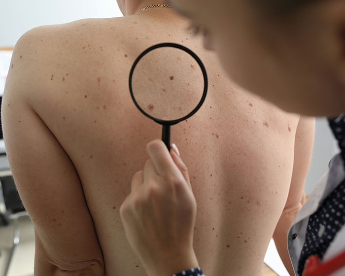Dermatologist examining a patient's back with a magnifying glass to check for skin problems or a red flag. Dermatologist examining a patient's back with a magnifying glass to check for skin problems or a red flag.