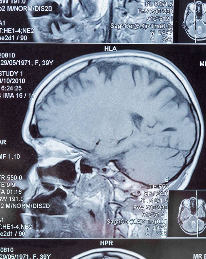 A medical scan showing a sagittal view of a human brain, part of an investigation into a suspected brain cancer horror story.