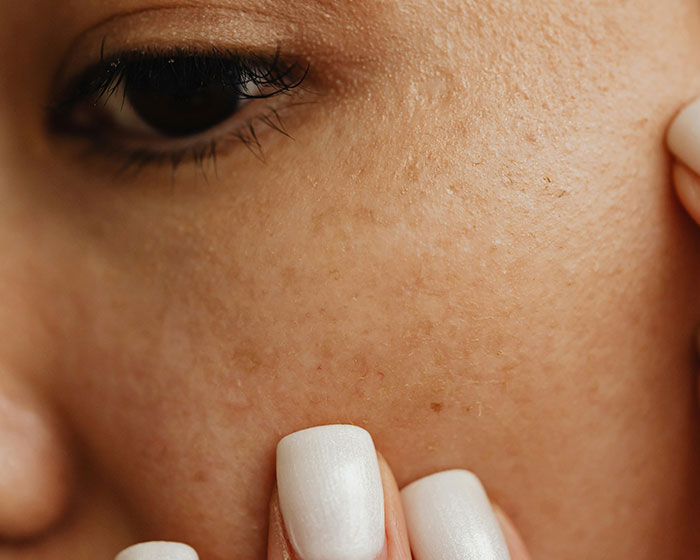 Close-up of a person's skin with freckles and moles, highlighting potential skin problems. Close-up of a person's skin with freckles and moles, highlighting potential skin problems.