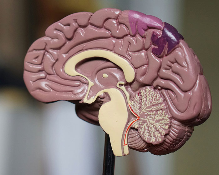 Anatomical model of a human brain, illustrating areas potentially affected by dementia.