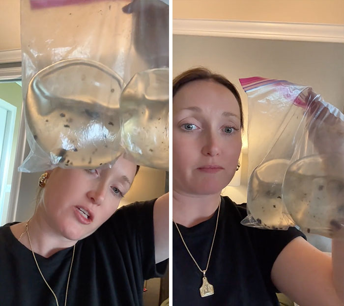 Woman holding up a plastic bag containing her explanted breast implants, revealing the condition. Woman holding up a plastic bag containing her explanted breast implants, revealing the condition.