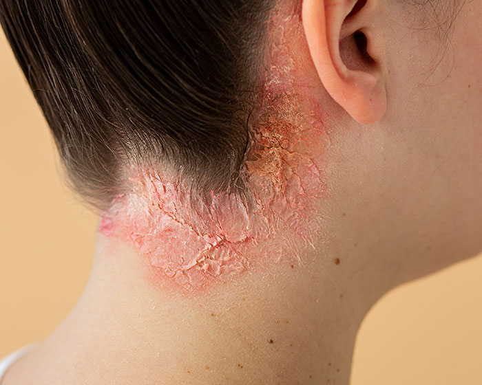 Close-up of a person's neck with a visible red, scaly skin problem, possibly a red flag for health. Close-up of a person's neck with a visible red, scaly skin problem, possibly a red flag for health.