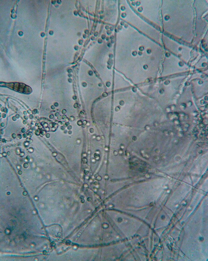 Microscopic view of fungi, a creepy discovery related to a suspected brain cancer horror story.